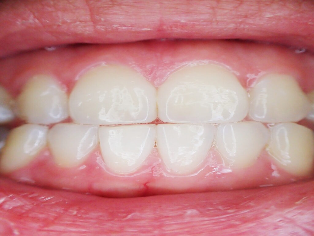 teeth_gums_prevent_gum_bleeding